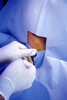 Znieczulenie zewnątrzoponowe